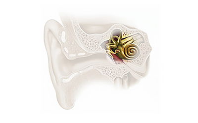 Pérdida Neurosensorial